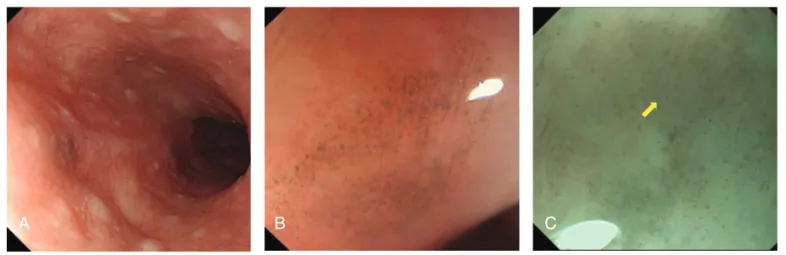 Figure 2. Melanocytosis of the esophagus in case 1. (A) Endoscopy revealed a view similar to PMME