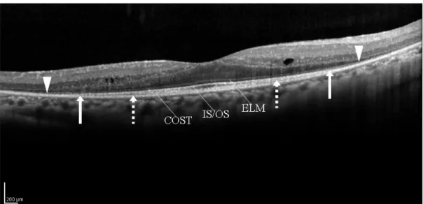 Figure 10. Spectral - domain optical coherence tomographic (SD- OCT) image of an eye with retinitis pigmentosa (52 - year - old man).