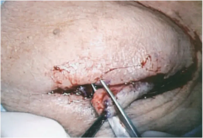 Figure 1A : Incision marked