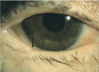 Figure 3B : Complications of the conjunctiva palpebrae Minimal symblepharon is observed.