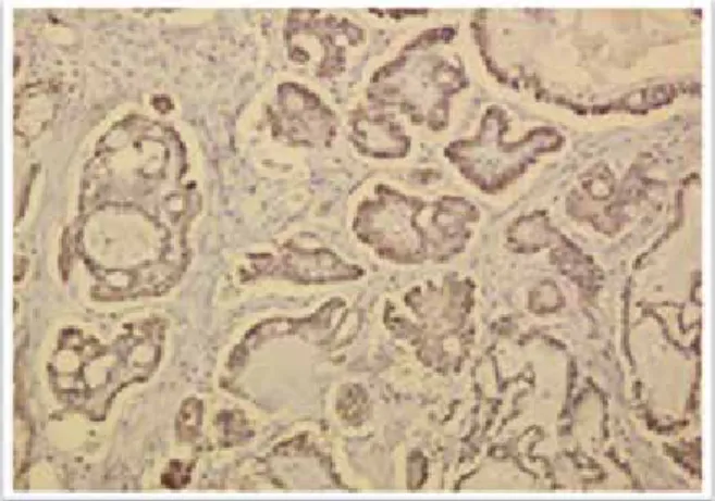 Figure 4. 　Moderate diffuse positive nuclear reaction to ER in most  of tumor cells (X10).