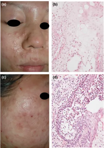 Figure 1. Clinical and histological features of (a,b) case 1 and (c,d) case 2. (a) There were coalescent, erythematous plaques with pustules on the edematous face