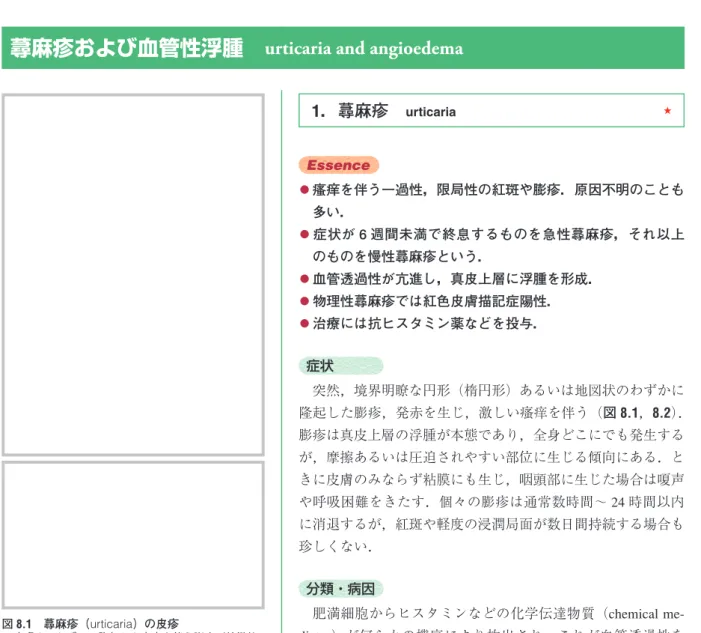 図 8.1　蕁麻疹（urticaria）の皮疹 皮膚よりわずかに隆起した瘙痒を伴う膨疹が特徴的．蕁麻疹，痒よう疹しん，皮膚瘙そう痒よう 症は，瘙痒を主体とする炎症性の皮膚疾患群であり，これらを便宜上 1 つの章にまとめて解説する．この疾患群の共通性は，臨床的な強い瘙痒だけであり，発症機序や臨床像，病理所見に共通性があるというわけではない．8章  蕁麻疹・痒疹・皮膚瘙痒症