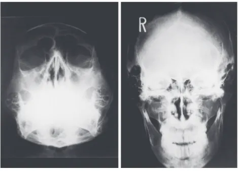 Fig. 2 X-ray films of the Case 1 note: the clouding of the bilateral maxillary sinus.