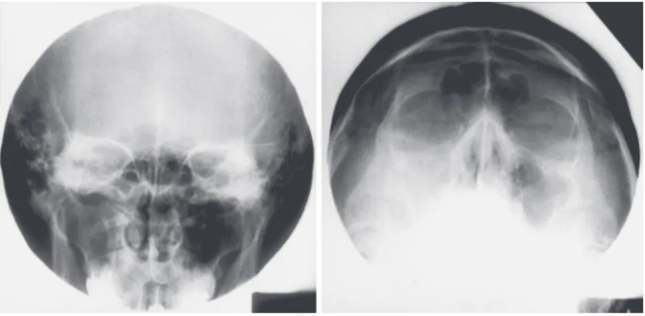 Fig. 4 X-ray films of the Case 2 note: the clouding of the maxillary sinus, rt.