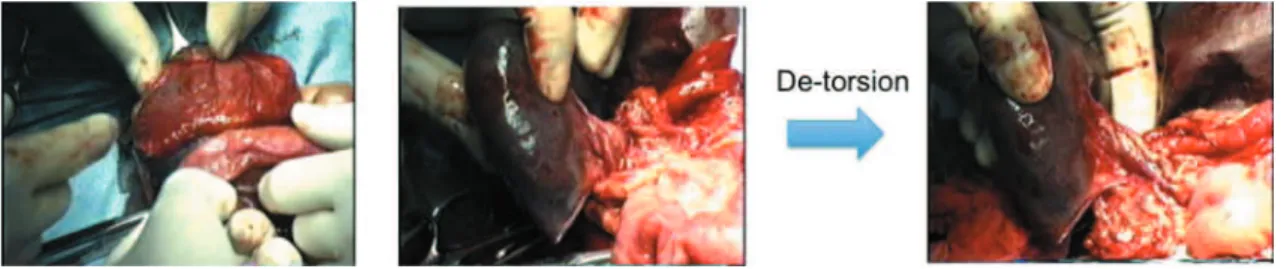 Table 1 Case reports of children with torsion of an accessory spleen