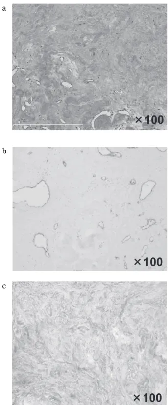 Figure 4 : Macroscopic findings of the resected tumor. The tu- tu-mor was a well - demarcated homogenous white solid nodule, 0.8 ! 0.7 cm in size