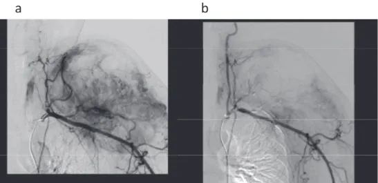 Figure 2 : Case 5. DSA of right external iliac artery ; a : pre - embolization, b : postembolization