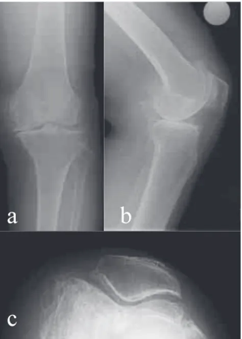 Figure 2 : Postoperative radiographs and computed tomography images showing patellar dislocation of the left knee