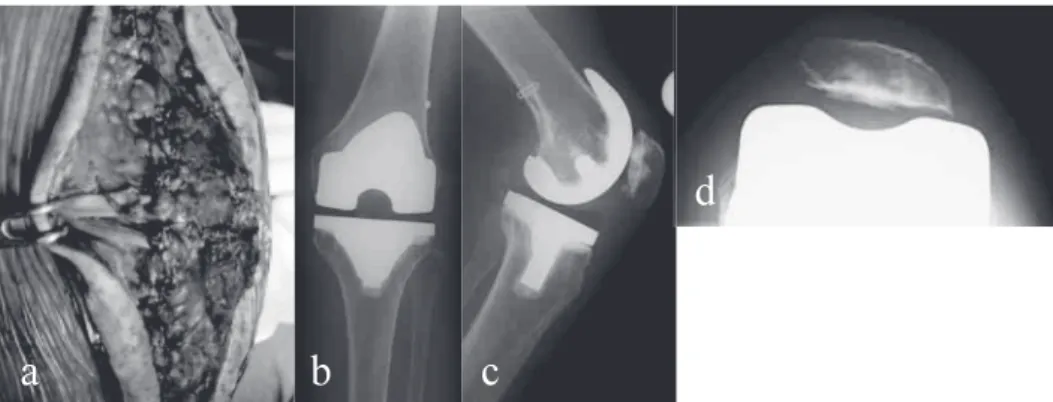 Figure 3 : Medial patellofemoral ligament (MPFL) reconstruction for patellar dislocation
