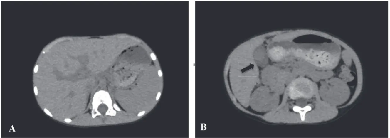 Figure 2. Plain computed tomography on admission suggests acute hepatitis or cholescystitis.