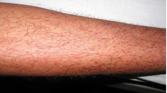 図 1 ． ン 熱患者 発疹：解熱時期 み た点状出血
