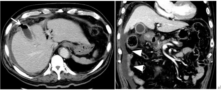 図 14　胆汁性腹膜炎 2