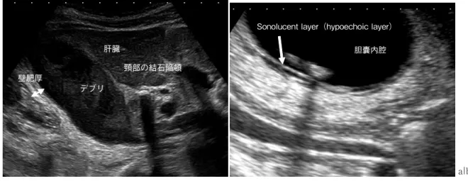 図 1　急性胆囊炎の超音波所見