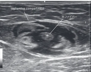 図 9   TLA麻酔浸潤時の超音波所見 Saphenous compartment 内に浸潤さ れた麻酔液が，短軸像で同心円状の低 輝度領域として観察される。光ファイバーsaphenous compartment 図 10   浅在性静脈のTLA麻酔 皮下を走行する浅在性の静脈（ A ）は，皮膚との距離が 1cm 以上となるように TLA 麻酔液を浸潤する（ B ）。GSVGSV1cmAB 図 11   TLA麻酔による脛骨神経の剝離