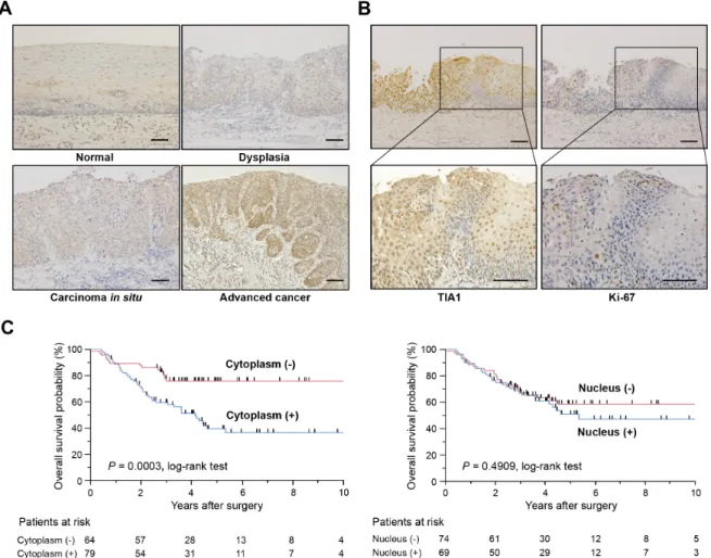 Figure 1: TIA1 protein overexpression and localization and its association with overall survival in primary ESCC  tumors