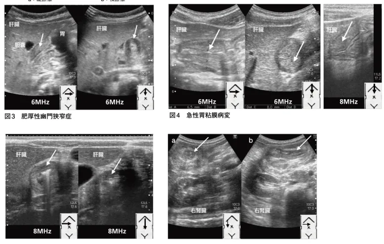 図 4　急性胃粘膜病変 のコツは肝臓をエコーウインドウにして 幽門部を描出すること，右側臥位にし て幽門部に胃内容を移動させ，ガスの 影響を避けることである。 2 ）急性胃粘膜病変 急性胃粘膜病変は，何らかの精神的 ストレスが誘因となり，急激な上腹部 痛と嘔気・嘔吐を来す疾患で，内視鏡 で胃前庭部に粘膜の発赤，びらん，浅 い潰瘍を認める。年長児に多いが，最 近では幼児例も経験する。本症は臨床 症状とエコー所見のみで診断可能な疾 患のひとつである。輸液でなかなか軽快 しない心窩部痛や嘔吐を認める場合には， 本