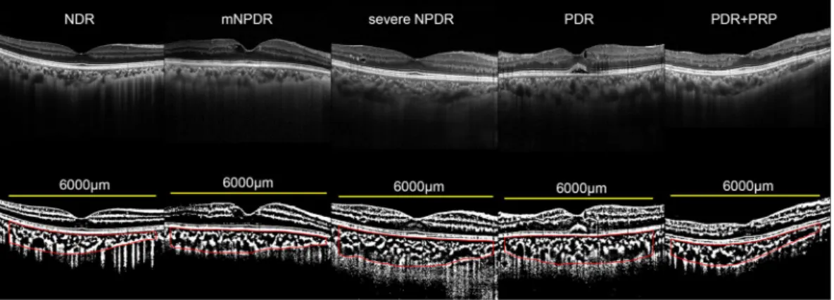 Figure 1.  Enhanced depth imaging optical coherence tomographic (EDI-OCT) images and binarized images  of EDI-OCT acquired from eyes with different stages of diabetic retinopathy