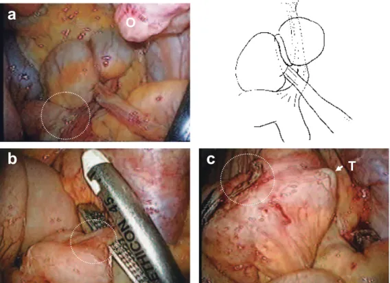 Fig． １：Abdominal CT findings （a） and radiography by a long tube （b） revealed dilated small bowel with stricture in the ileum （arrows）