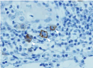 Fig． ４：Immunohistochemical staining showed CD ３ ０（+） Reed Ster- Ster-berg cells in the interstitial tissue of the resected greater omentum （arrows, ×２ ０ ０） ．