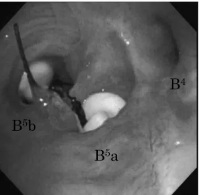 Fig． ３：EWS の充填：B ５ a，B ５ b に EWS を充填した。