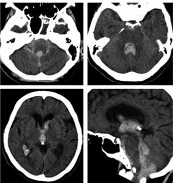 Figure 1. 　Plain head computed tomography on admission showing  subarachnoid hemorrhage located predominantly in the cisterna  mag-na and hematoma in the 4 th , 3 rd , and bilateral lateral ventricles.