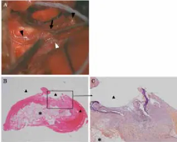 Figure 3. 　Intraoperative photograph showing the afferent arteries  (black triangle head), the efferent artery (white triangle head), and  the aneurysm covered with clot and a cottonoid (black arrowhead)