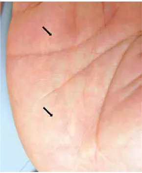Fig 2. 　Keratotic papules on the right palm (arrows)