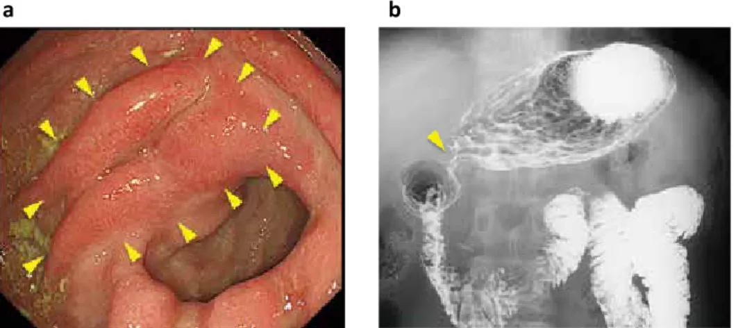 Figure 2. 　Intraoperative finding and resected specimen. (a) There was scarring at the delta-shaped anastomosis