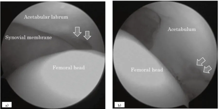 Figure 2. 　Intraoperative arthroscopy. a) Antero-lateral acetabular labrum shows  slight redness but no detachment