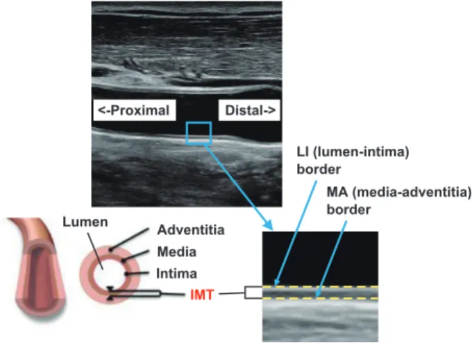 Fig. 1  Typical ultrasound B-mode image of a carotid artery and IMT.