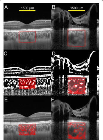 Figure 2 Enhanced depth imaging optical coherence tomographic (EDI-OCT) images and converted binary images.