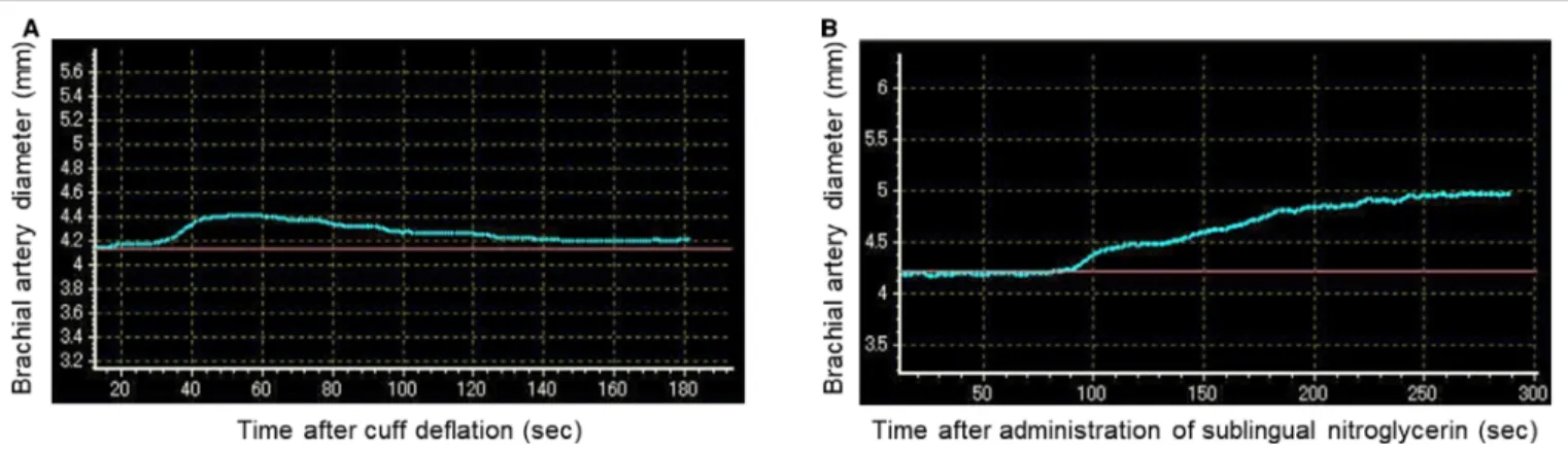 Figure 1. Representative images of change in brachial artery diameter after cuff de ﬂ ation for measurement of ﬂ ow-mediated vasodilation (A) and after administration of a sublingual nitroglycerin tablet for measurement of nitroglycerin-induced vasodilatio