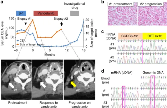 Fig. 1 Identiﬁcation of a RET-S904F mutation conferring resistance to vandetanib. a Clinical course of the patient and axial chest computed tomographic (CT) scan