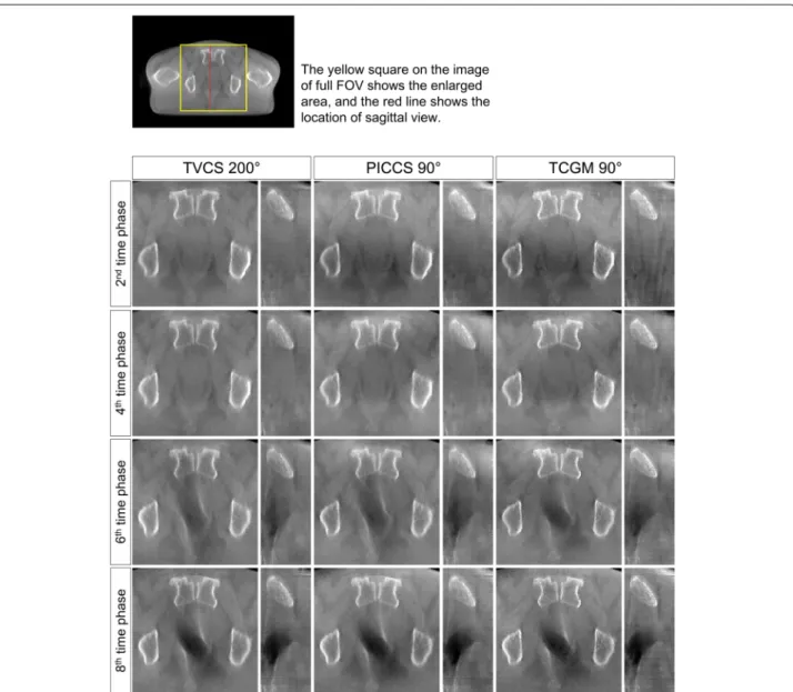 Fig. 9 demonstrate that the artifact from rectum is the weakest in the image (e) reconstructed by the TCGM, so the TCGM was the best method for reducing motion artifacts.