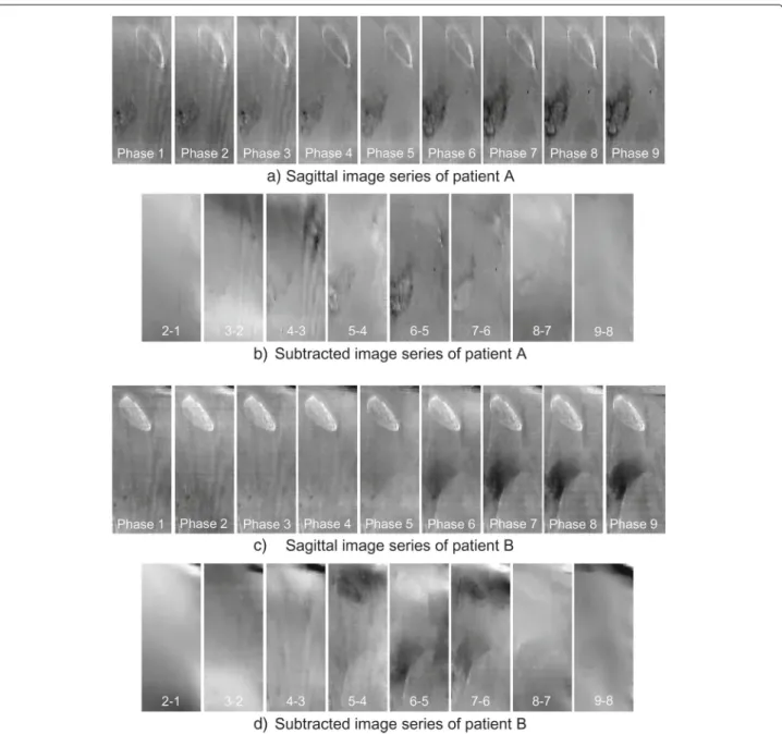 Fig. 10 Sagittal image series and subtracted image series of patient A and B reconstructed using the TCGM (90 ◦ )