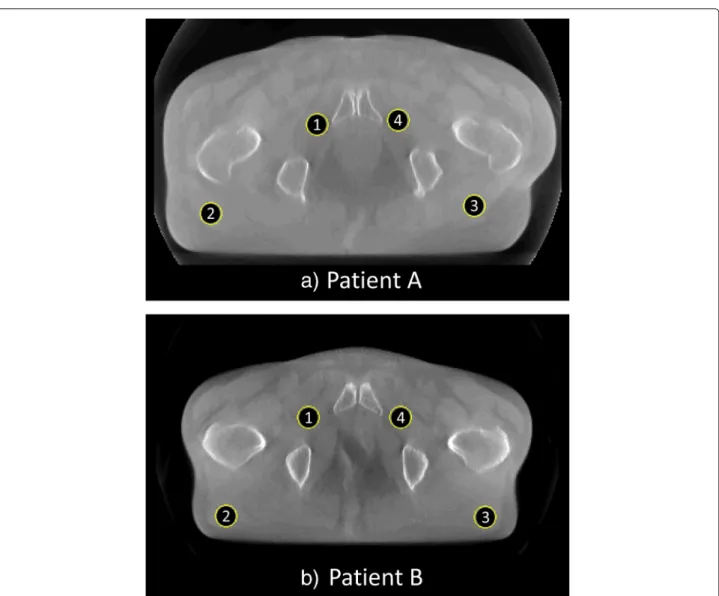 Fig. 4 Location of the ROIs for pixel value consistency evaluation. Mean pixel values of ROIs 1 to 4 are evaluated for both patient A and B