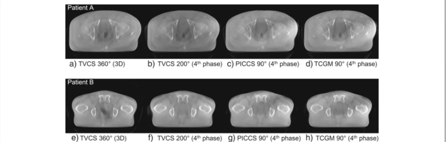 Figure 5 shows the reconstructed axial and sagittal images of the digital phantom with the sphere speed of 3 cm/60 s using the TCGM method (90 ◦ projection range)