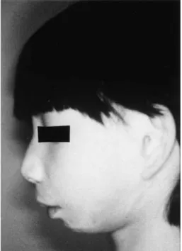 Fig. 3. Postoperative profile shows marked improvement in appearance.
