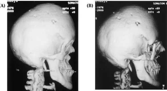 Fig. 6. (A) Preoperative computed tomography scan showing severe maxillary retrusion. (B) Postoperative computed tomogra- tomogra-phy scan showing that the upper segment is substantially advanced.