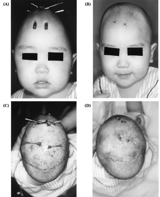 Fig. 7. Frontal views before (A) and after (B) distraction. Top views before (C) and after (D) distraction.