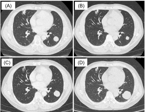 Figure 2. Chest computed tomography findings. (A) At the initial visit. A nodule, which was 23 mm  in diameter, was seen in the left lower lobe (S 8 )