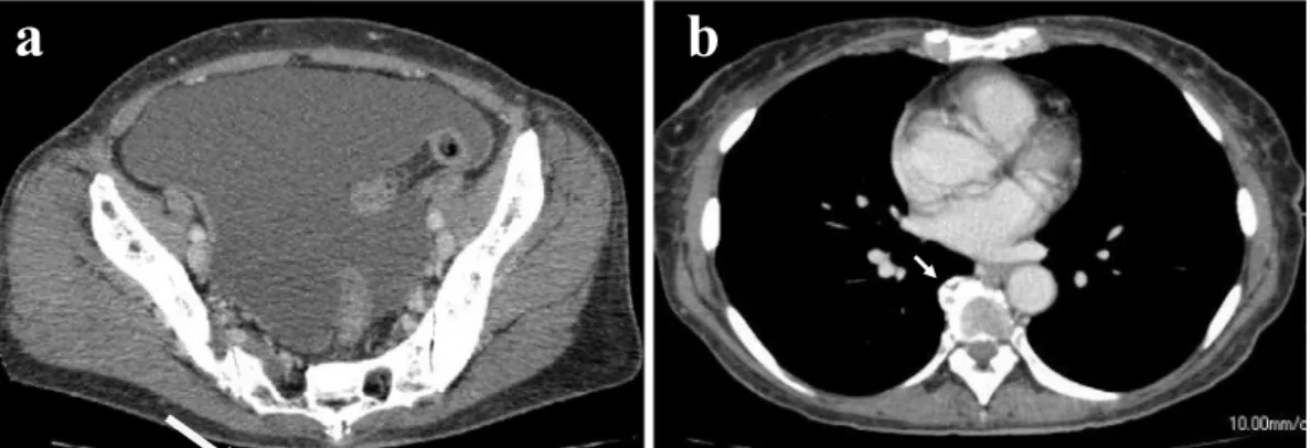 Figure 1. Contrast-enhanced CT showed massive ascites (a) and an abnormal bone formation ad- ad-jacent to the thoracic spine (b, arrow).