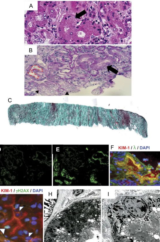 Figure 1. The kidney biopsy findings: Hematoxylin and Eosin staining (A) and Periodic acid-Schiff  staining showed (B) swelling (arrow), loss of brush boarder (surrounded by a dotted line) and  detach-ment from the basedetach-ment membrane (arrowhead) in t