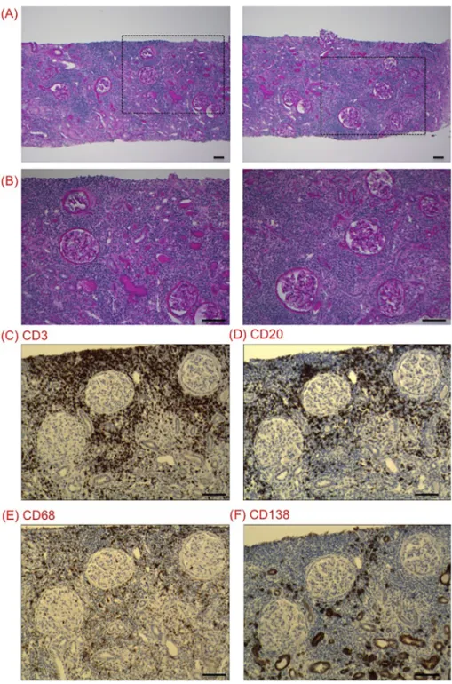 Figure   1.   Representative pictures obtained from the first biopsy. (A, B) Diffuse interstitial cell infil- infil-tration was observed with interstitial fibrosis  and tubular atrophy