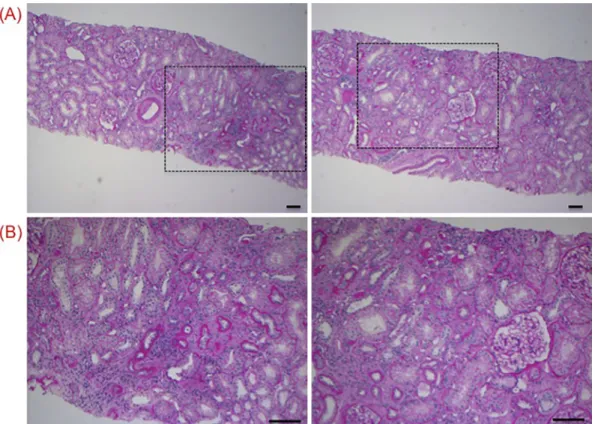 Figure 3. Representative pictures obtained from the second biopsy. (A, B) Corticosteroid therapy  decreased inflammatory cell infiltration and improved tubular atrophy in the kidneys