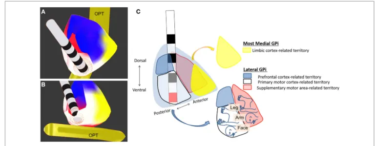 FiGURe 1 | Deep brain stimulation of the globus pallidus internus (GPi). Electrodes are placed in the ventroposterolateral part of the GPi (the 
