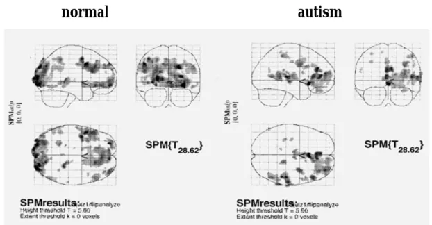 Fig. 2. A statistical parametric map (SPM) as a maximum intensity projection showing the activated areas.