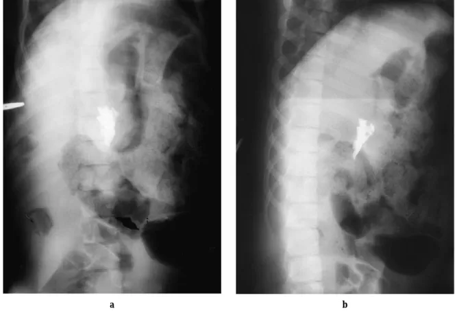 Figure 1. The fluoroscopy showed the lipiodol image at the time of injection to case G.