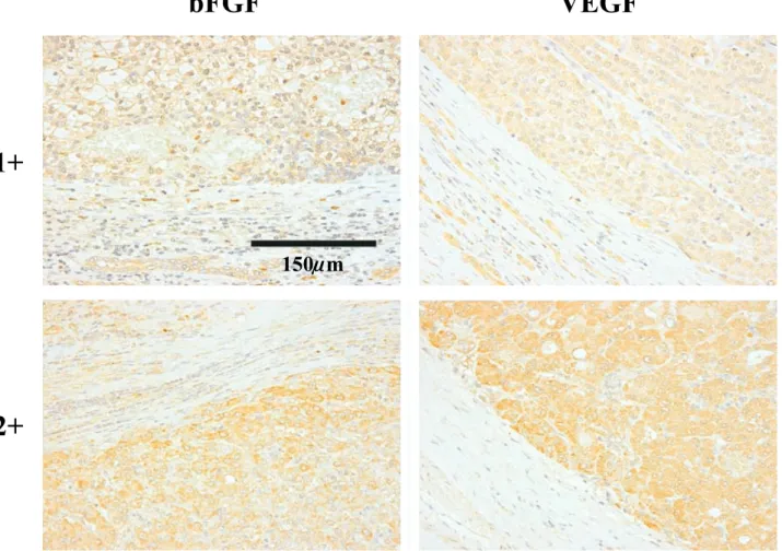 Figure 2. Immunohistochemical expression of bFGF and VEGF in HCC. The cytoplasmic intensity of epithelial cells of bile ducts in non-neoplastic liver was considered the control of immunohistochemical staining for bFGF and VEGF